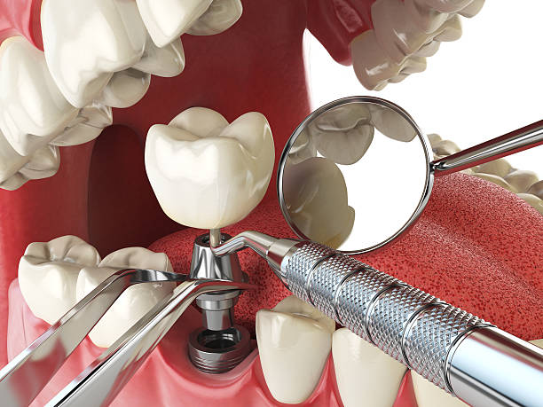 Best Emergency Wisdom Teeth Removal in Gold River, CA